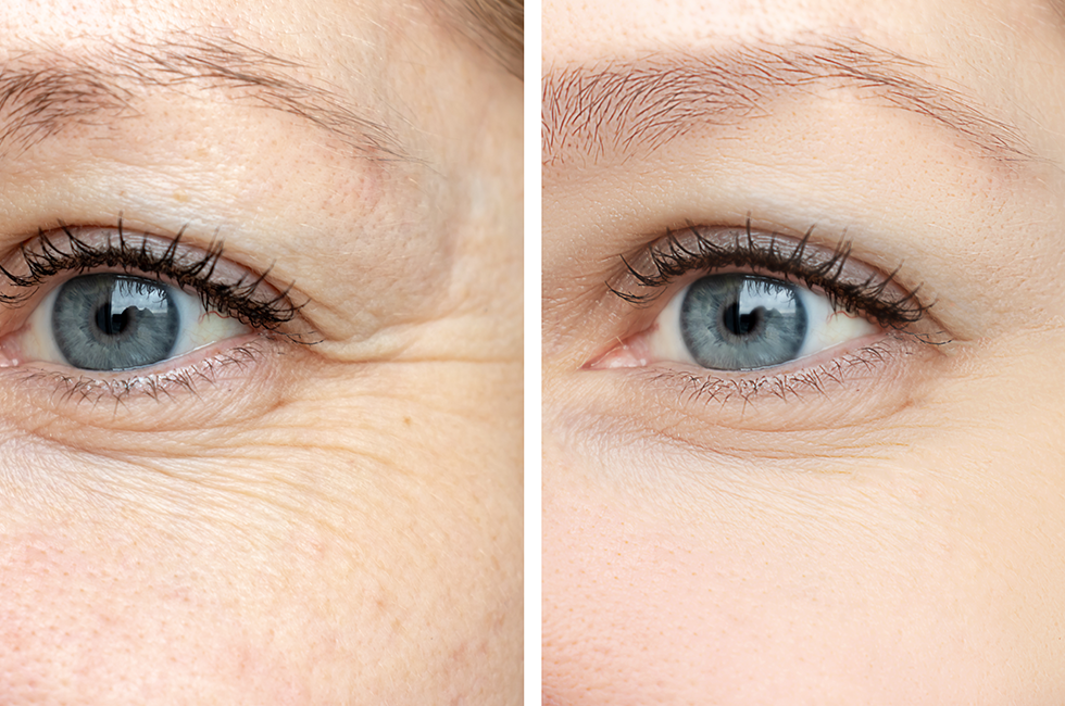 A before and after shot of a woman’s eyes showing the effect of a Botox treatments