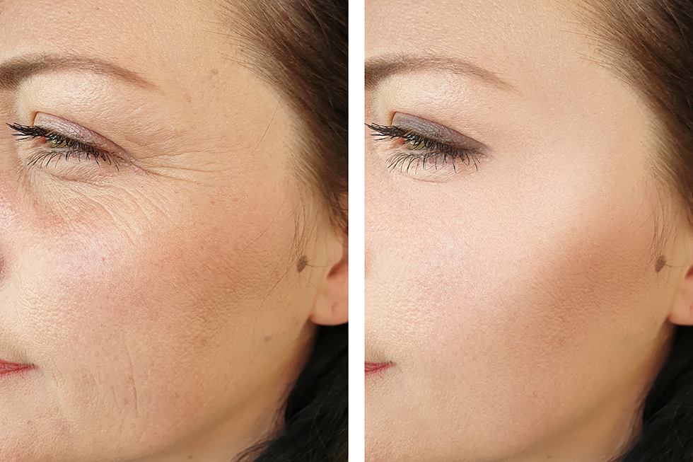 A before and after image of a woman who received Morpheous8 microneedling around her eyes and cheeks | Morpheous8 microneedling Boca Raton