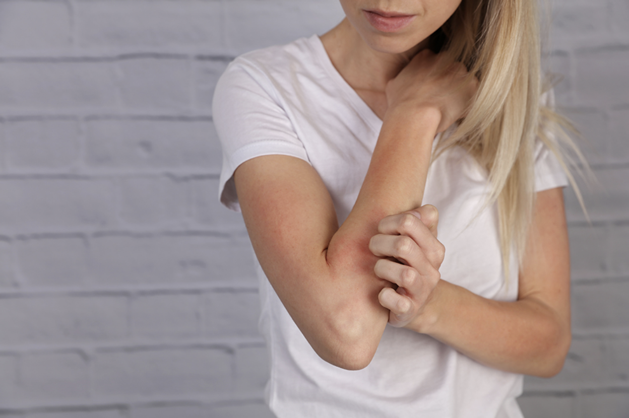 A Boca Raton woman suffering from eczema, scratching her irritated forearm