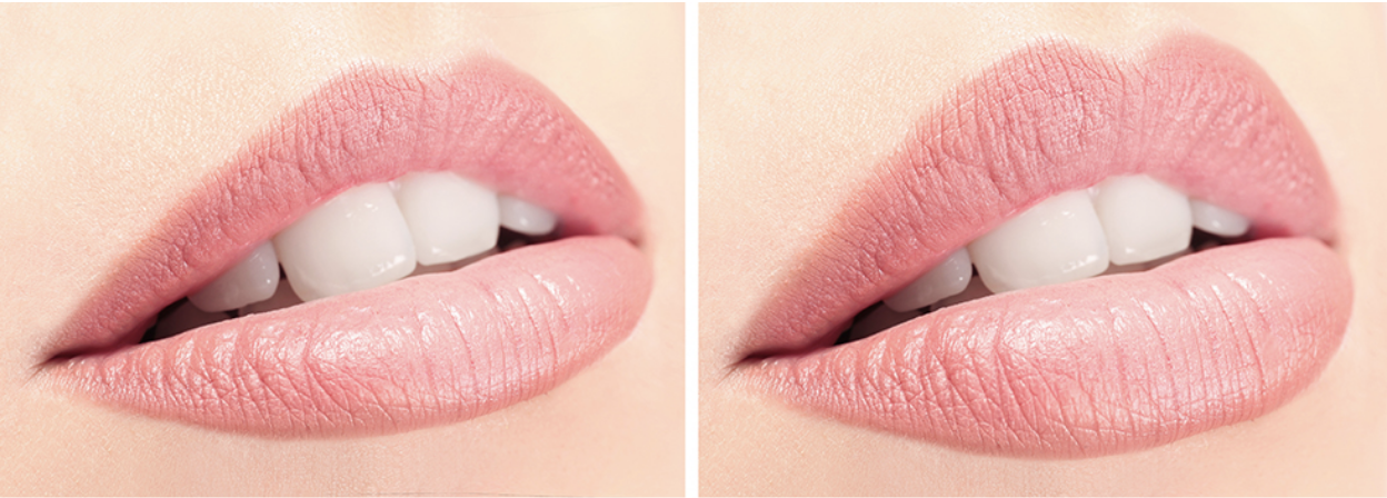 A before and after of a lip filler enhancement by Frieder Dermatology in Boca Raton