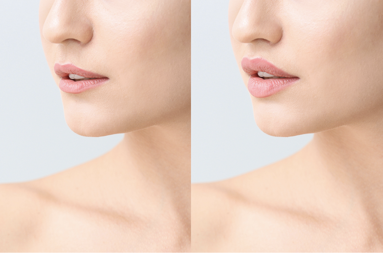 A before and after of a lip filler enhancement by Frieder Dermatology in Boca Raton
