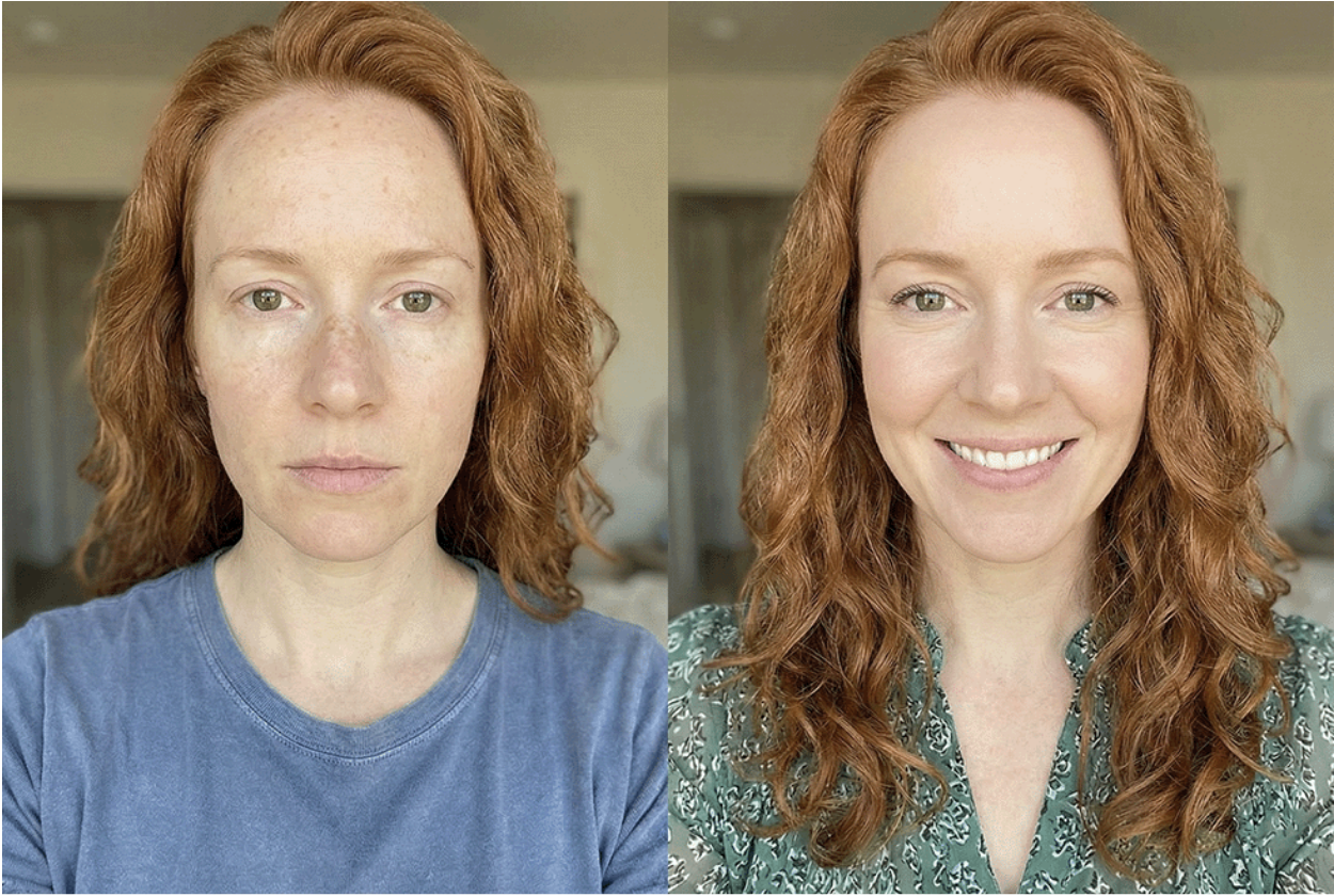 A before and after comparison of an IPL Photofacial treatment at Frieder Dermatology in Boca Raton.