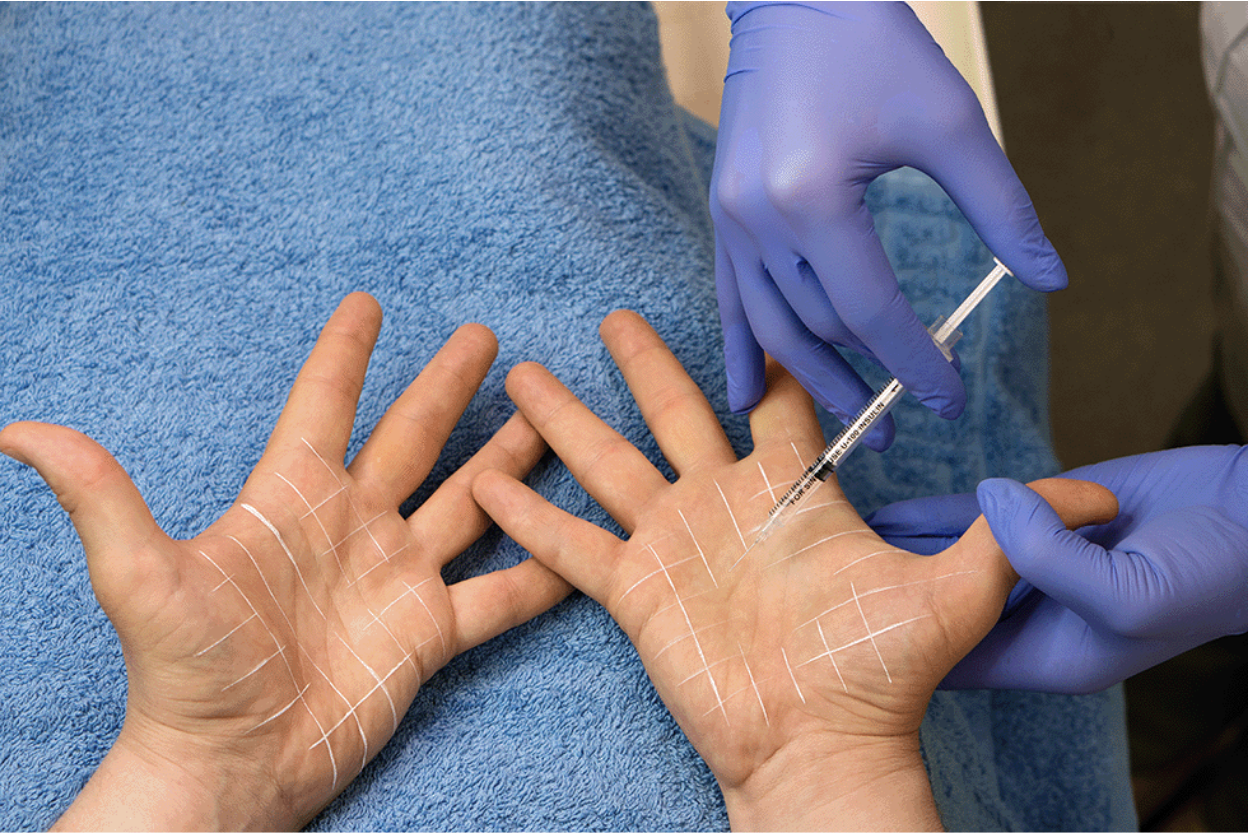 An injection treatment to the hands for hyperhidrosis using botox.