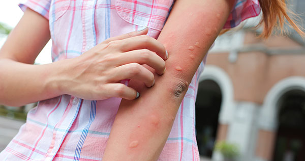 A woman is scratching mosquito bites on her arm.