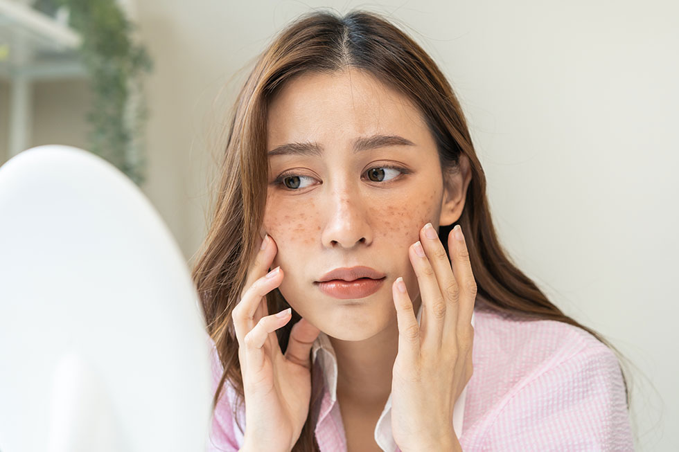 A young woman with a concerned look on her face as she inpects the melasma on her cheeks.